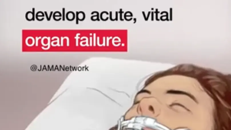 SOFA-2 impact in ICUs