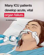 SOFA-2 impact in ICUs